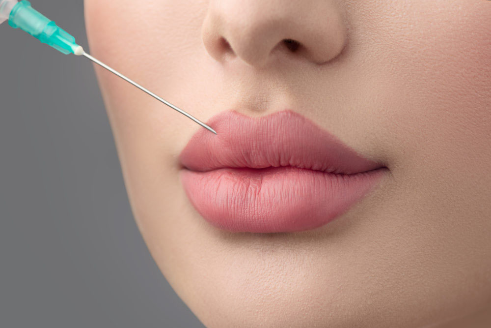 Lip fillers in Dubai